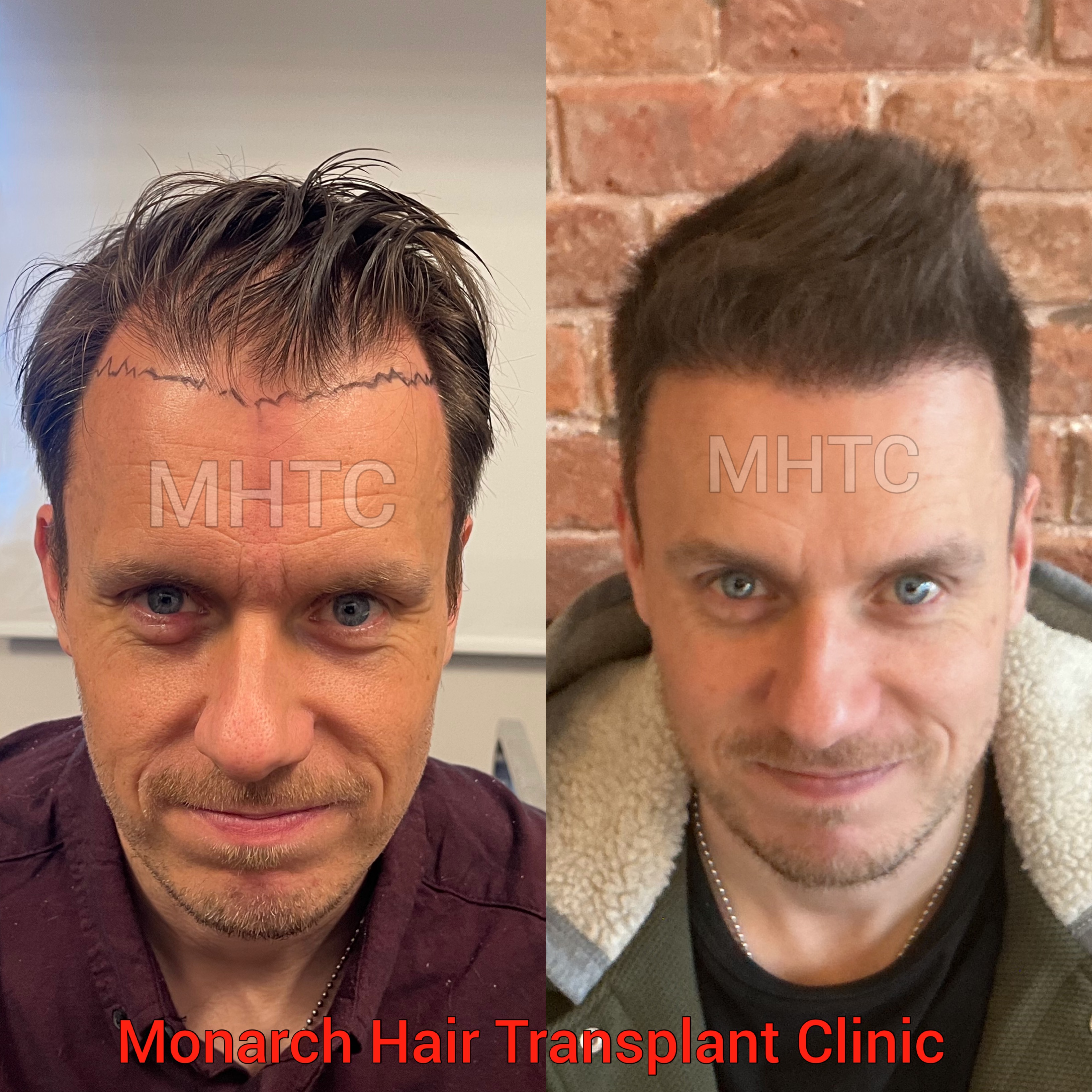 Damien feathered hairline and temple reconstruction 6-month results